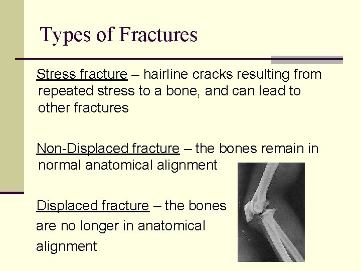 Types of Fractures Stress fracture – hairline cracks resulting from repeated stress to a