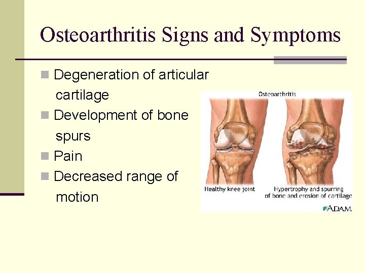 Osteoarthritis Signs and Symptoms n Degeneration of articular cartilage n Development of bone spurs