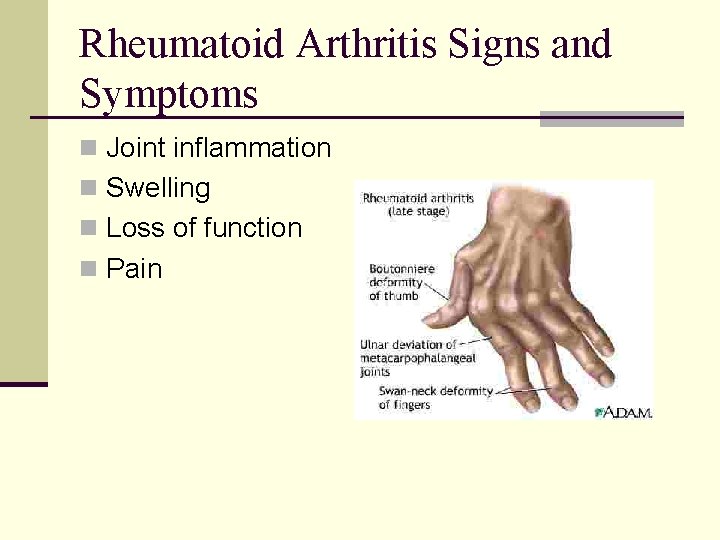 Rheumatoid Arthritis Signs and Symptoms n Joint inflammation n Swelling n Loss of function