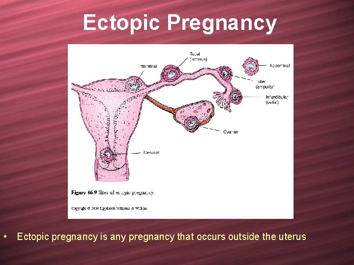 Ectopic Pregnancy • Ectopic pregnancy is any pregnancy that occurs outside the uterus 