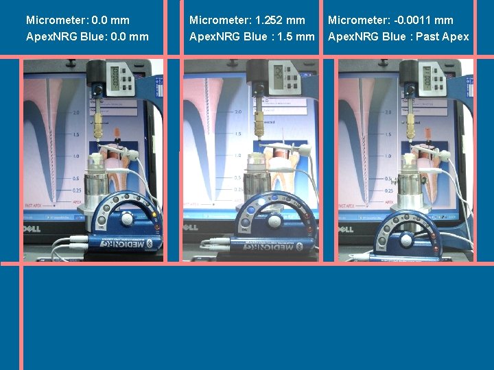 Micrometer: 0. 0 mm Apex. NRG Blue: 0. 0 mm Micrometer: 1. 252 mm Micrometer: 0. 0 mm Apex. NRG Blue: 0. 0 mm Micrometer: 1. 252 mm