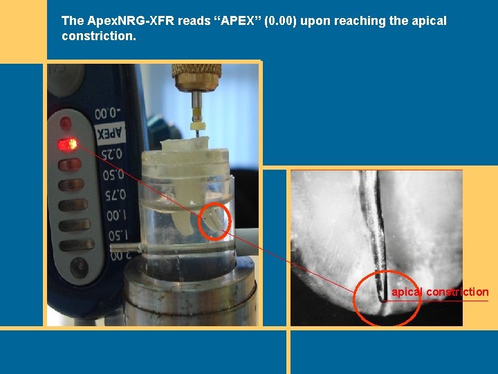 The Apex. NRG-XFR reads “APEX” (0. 00) upon reaching the apical constriction The Apex. NRG-XFR reads “APEX” (0. 00) upon reaching the apical constriction