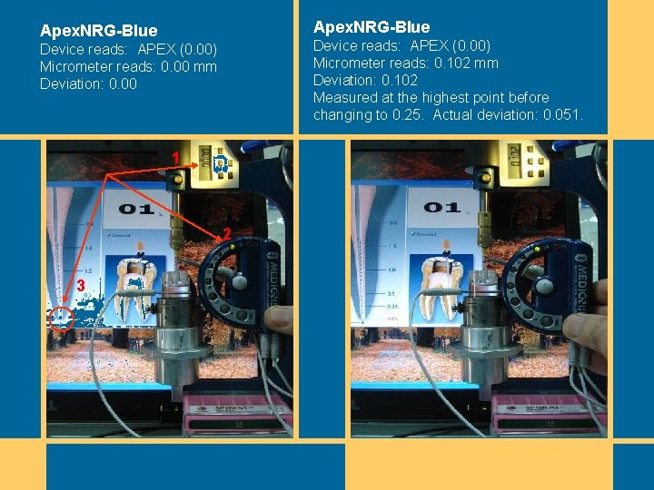 Apex. NRG-Blue Device reads: APEX (0. 00) Micrometer reads: 0. 102 mm Deviation: 0. Apex. NRG-Blue Device reads: APEX (0. 00) Micrometer reads: 0. 102 mm Deviation: 0.