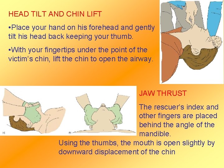HEAD TILT AND CHIN LIFT • Place your hand on his forehead and gently