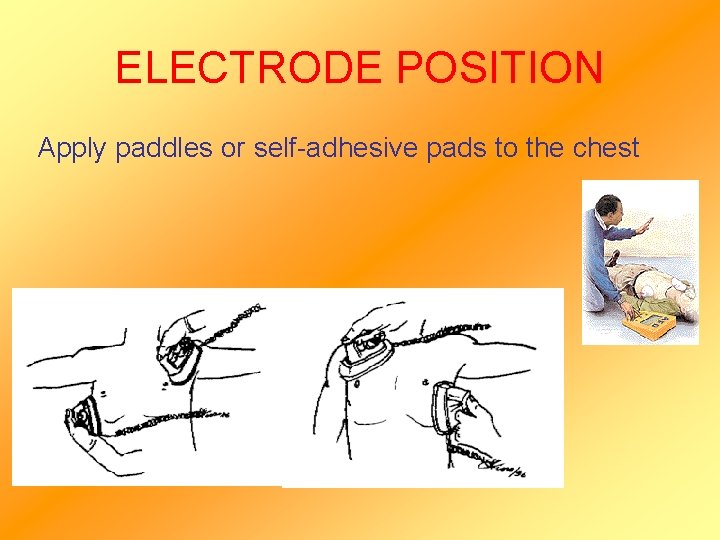 ELECTRODE POSITION Apply paddles or self-adhesive pads to the chest 