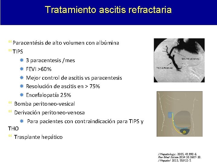 Tratamiento ascitis refractaria Paracentésis de alto volumen con albúmina TIPS 3 paracentesis /mes FEVI Tratamiento ascitis refractaria Paracentésis de alto volumen con albúmina TIPS 3 paracentesis /mes FEVI