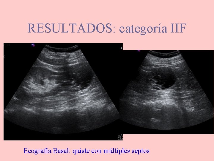 RESULTADOS: categoría IIF Ecografía Basal: quiste con múltiples septos 