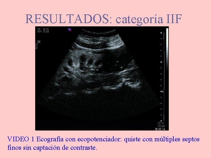 RESULTADOS: categoría IIF VIDEO 1 Ecografía con ecopotenciador: quiste con múltiples septos finos sin