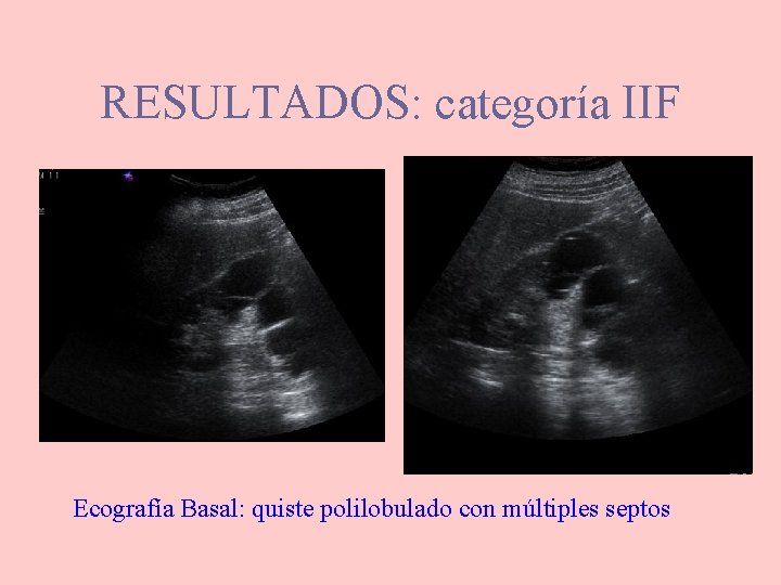 RESULTADOS: categoría IIF Ecografía Basal: quiste polilobulado con múltiples septos 