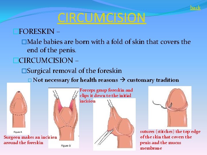 CIRCUMCISION back �FORESKIN – �Male babies are born with a fold of skin that
