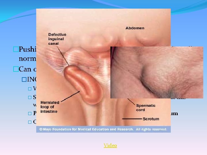 HERNIA �Pushing of a part of the body through the muscle wall normally keeping