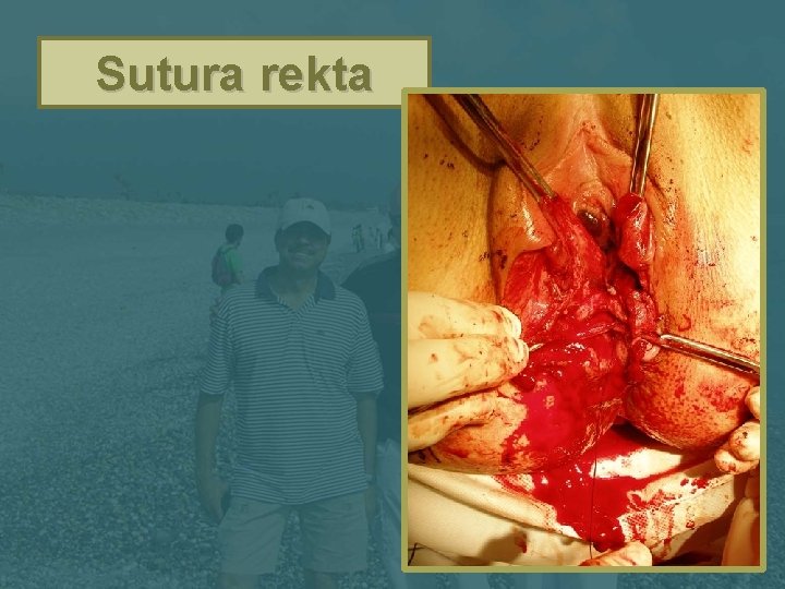 Sutura rekta 