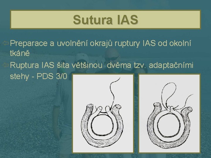 Sutura IAS ï Preparace a uvolnění okrajů ruptury IAS od okolní tkáně ï Ruptura