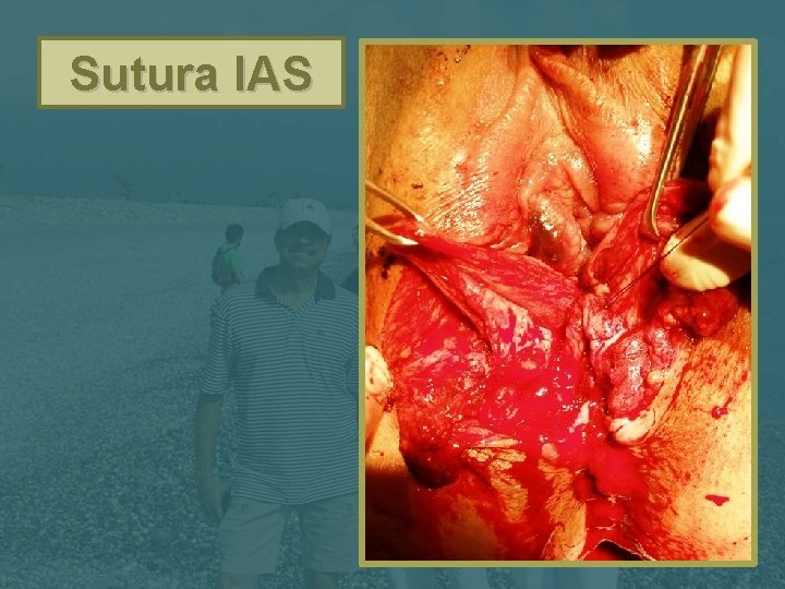 Sutura IAS 