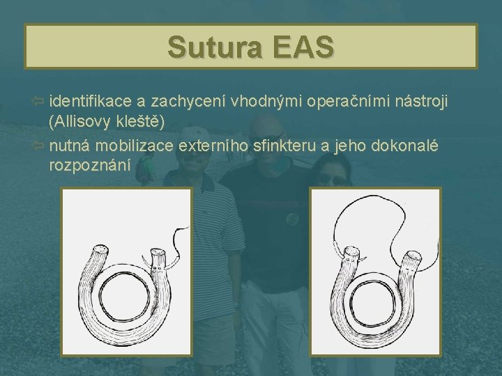Sutura EAS ï identifikace a zachycení vhodnými operačními nástroji (Allisovy kleště) ï nutná mobilizace