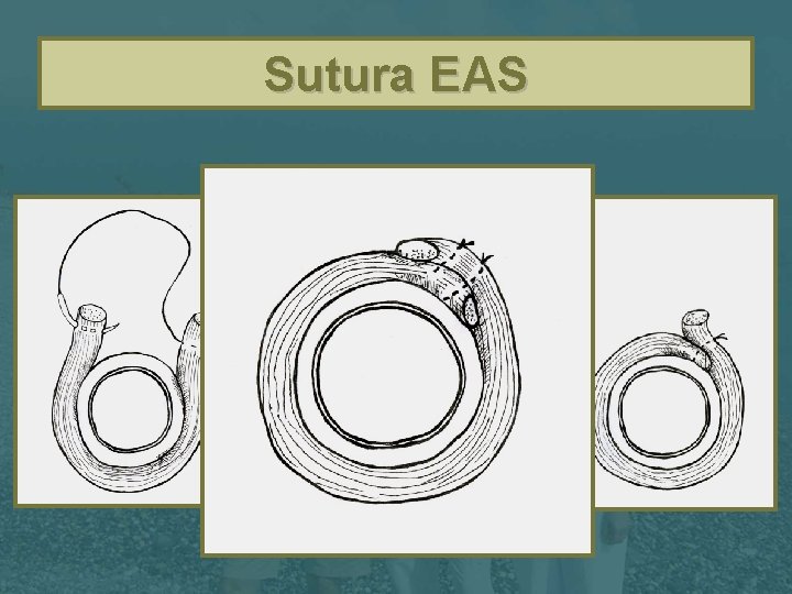 Sutura EAS 