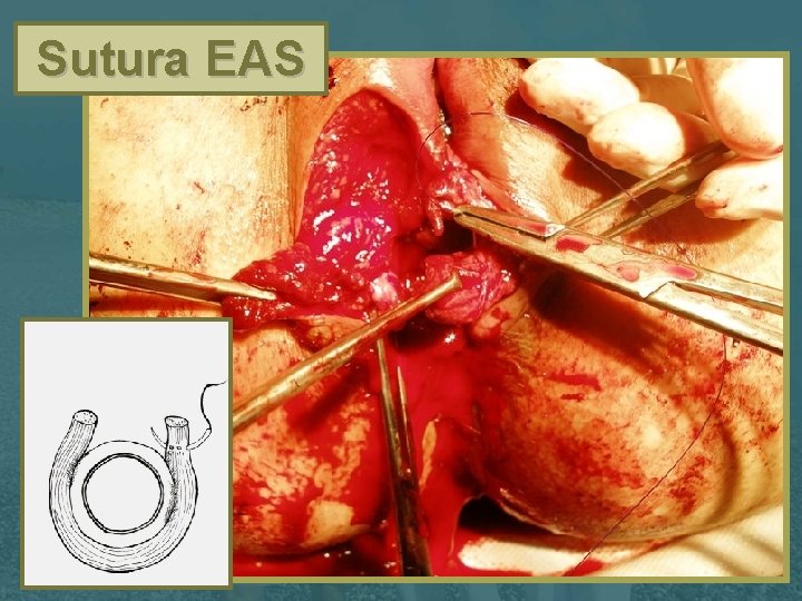 Sutura EAS 