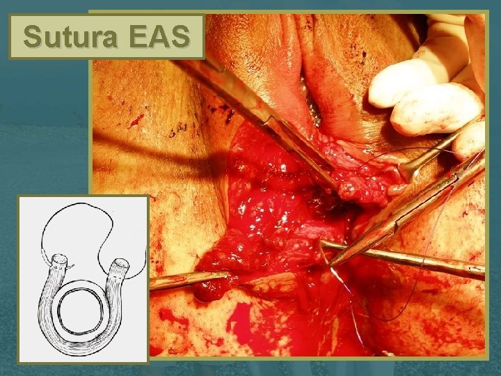 Sutura EAS 
