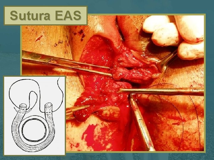 Sutura EAS 