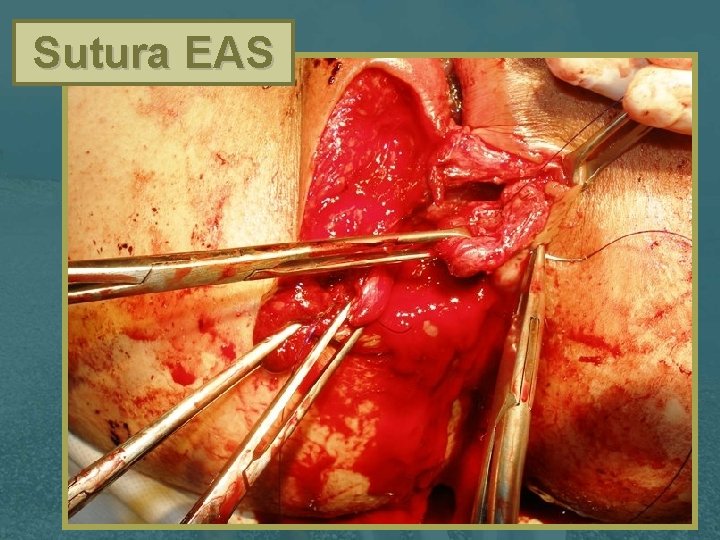 Sutura EAS 