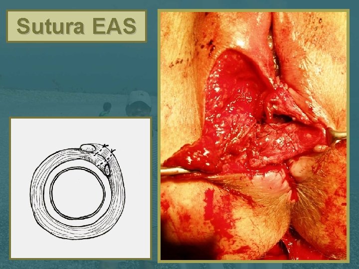 Sutura EAS 