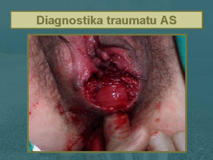 Diagnostika traumatu AS 