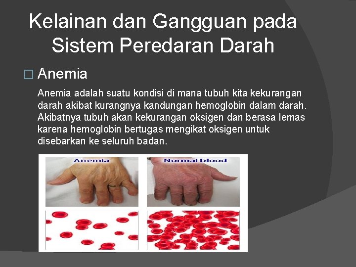 Kelainan dan Gangguan pada Sistem Peredaran Darah � Anemia adalah suatu kondisi di mana Kelainan dan Gangguan pada Sistem Peredaran Darah � Anemia adalah suatu kondisi di mana