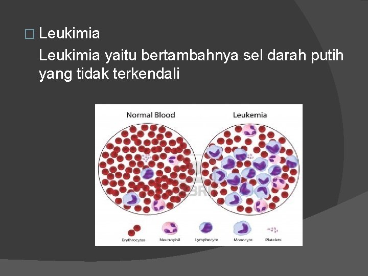 � Leukimia yaitu bertambahnya sel darah putih yang tidak terkendali � Leukimia yaitu bertambahnya sel darah putih yang tidak terkendali