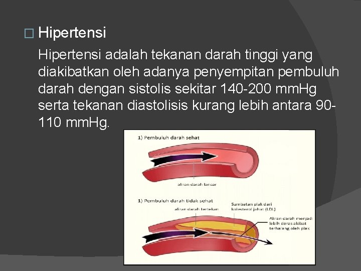 � Hipertensi adalah tekanan darah tinggi yang diakibatkan oleh adanya penyempitan pembuluh darah dengan � Hipertensi adalah tekanan darah tinggi yang diakibatkan oleh adanya penyempitan pembuluh darah dengan
