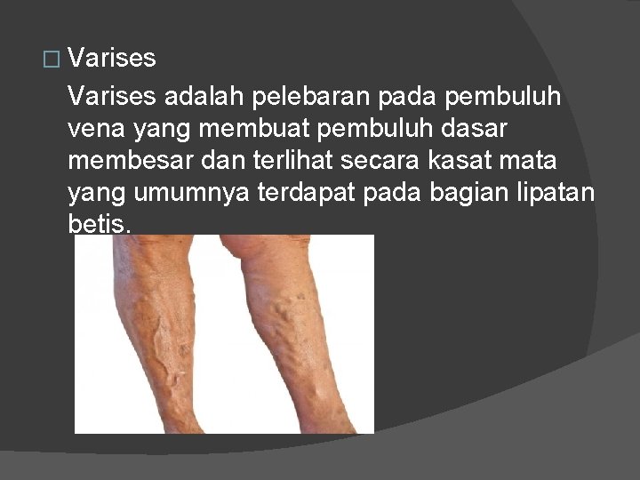 � Varises adalah pelebaran pada pembuluh vena yang membuat pembuluh dasar membesar dan terlihat � Varises adalah pelebaran pada pembuluh vena yang membuat pembuluh dasar membesar dan terlihat