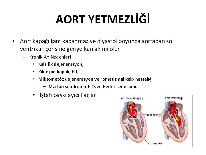 AORT YETMEZLİĞİ • Aort kapağı tam kapanmaz ve diyastol boyunca aortadan sol ventrikül içerisine