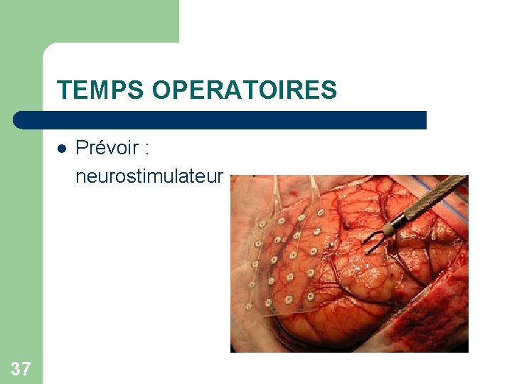 TEMPS OPERATOIRES l 37 Prévoir : neurostimulateur 