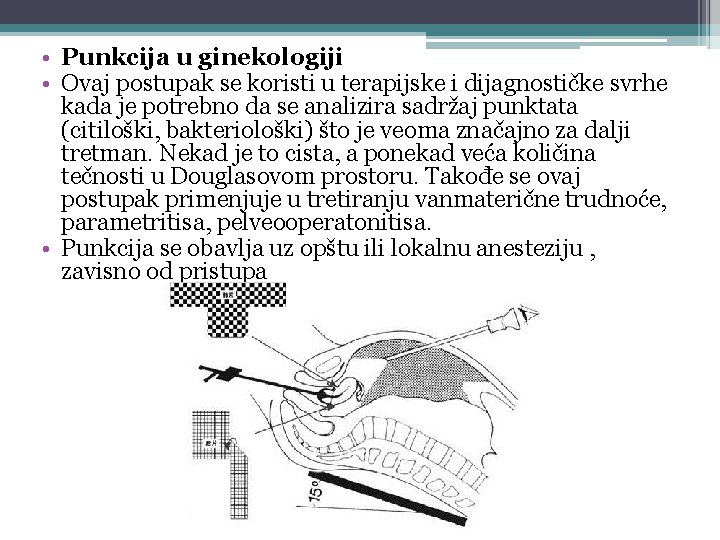  • Punkcija u ginekologiji • Ovaj postupak se koristi u terapijske i dijagnostičke