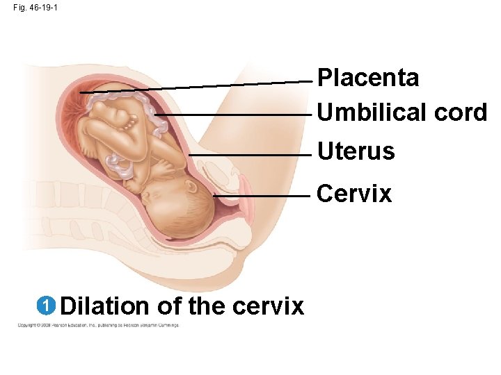Fig. 46 -19 -1 Placenta Umbilical cord Uterus Cervix 1 Dilation of the cervix