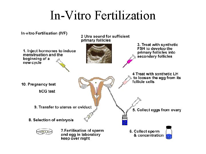 In-Vitro Fertilization 