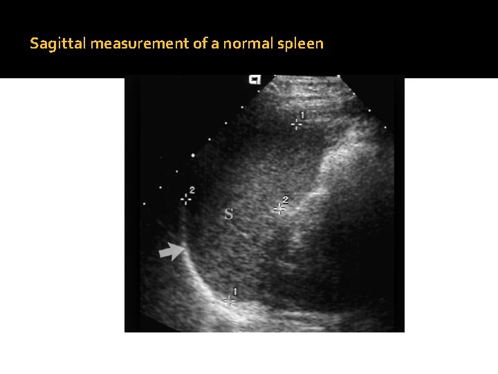 Sagittal measurement of a normal spleen 