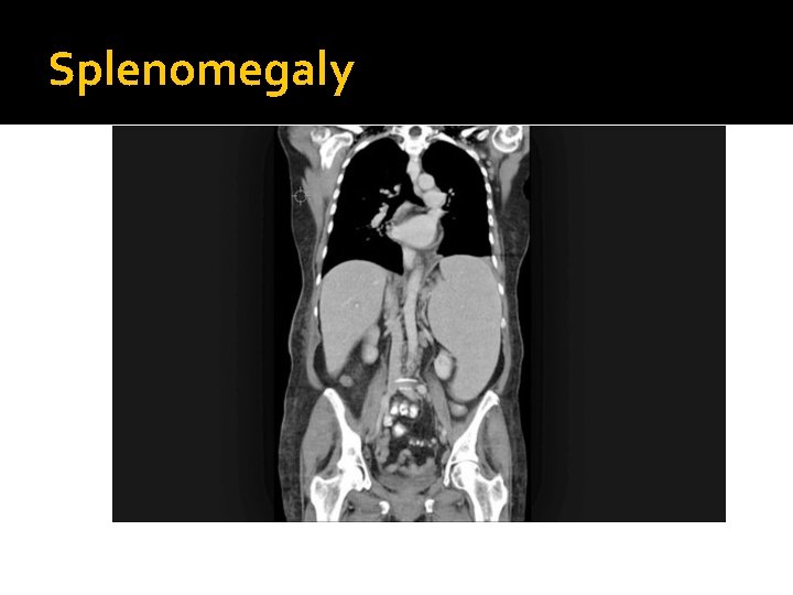 Splenomegaly 