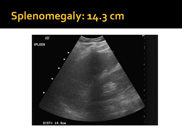 Splenomegaly: 14. 3 cm 