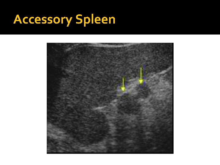 Accessory Spleen 