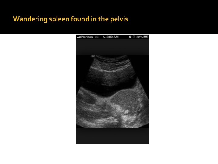 Wandering spleen found in the pelvis 