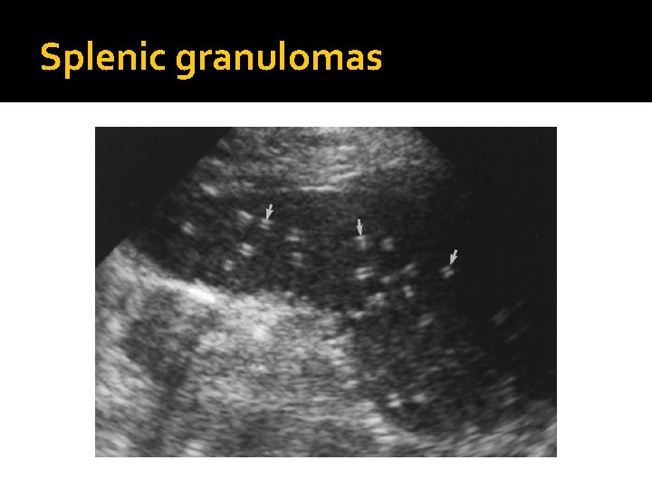 Splenic granulomas 