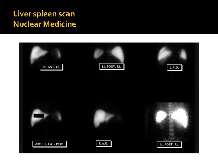 Liver spleen scan Nuclear Medicine 