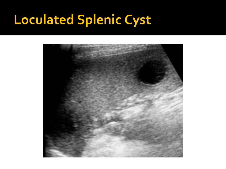 Loculated Splenic Cyst 