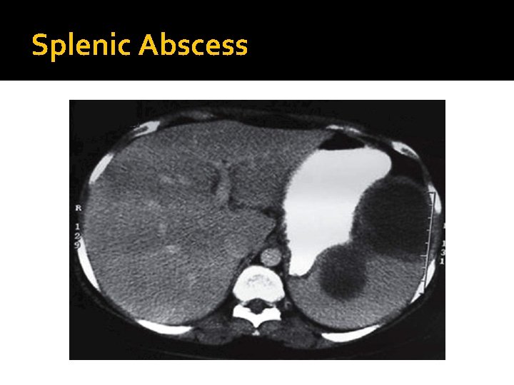Splenic Abscess 