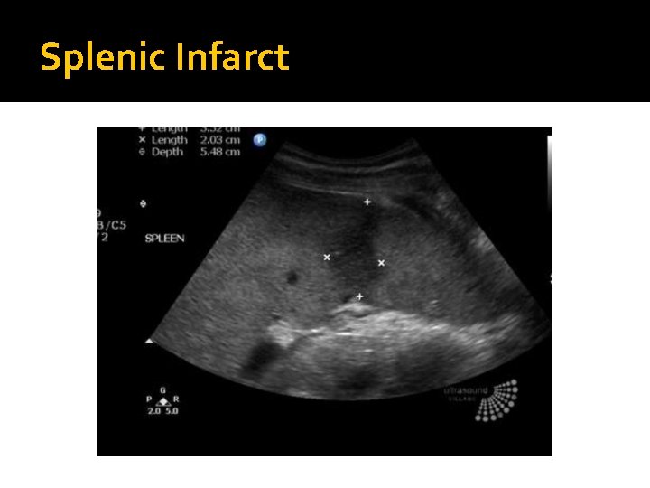 Splenic Infarct 