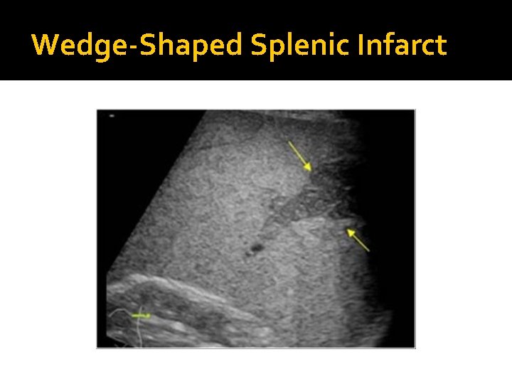 Wedge-Shaped Splenic Infarct 