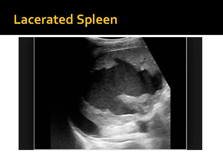 Lacerated Spleen 