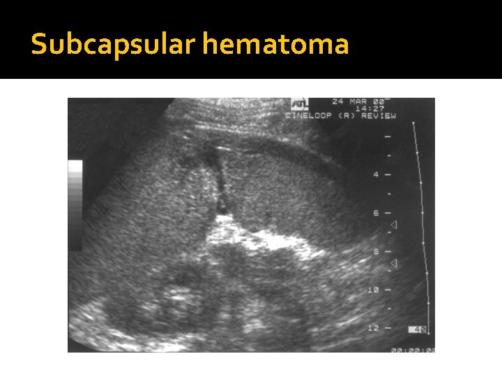 Subcapsular hematoma 