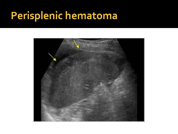 Perisplenic hematoma 