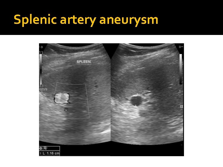 Splenic artery aneurysm 